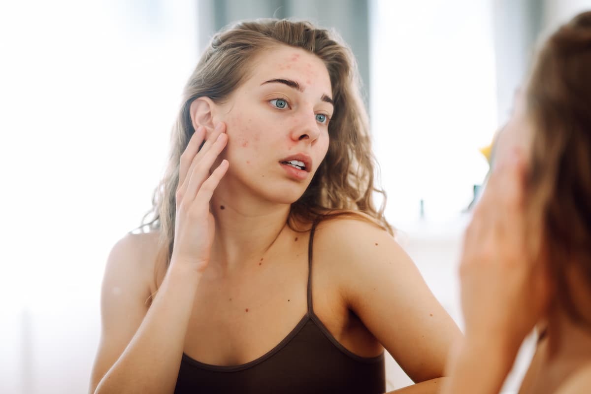woman with acne