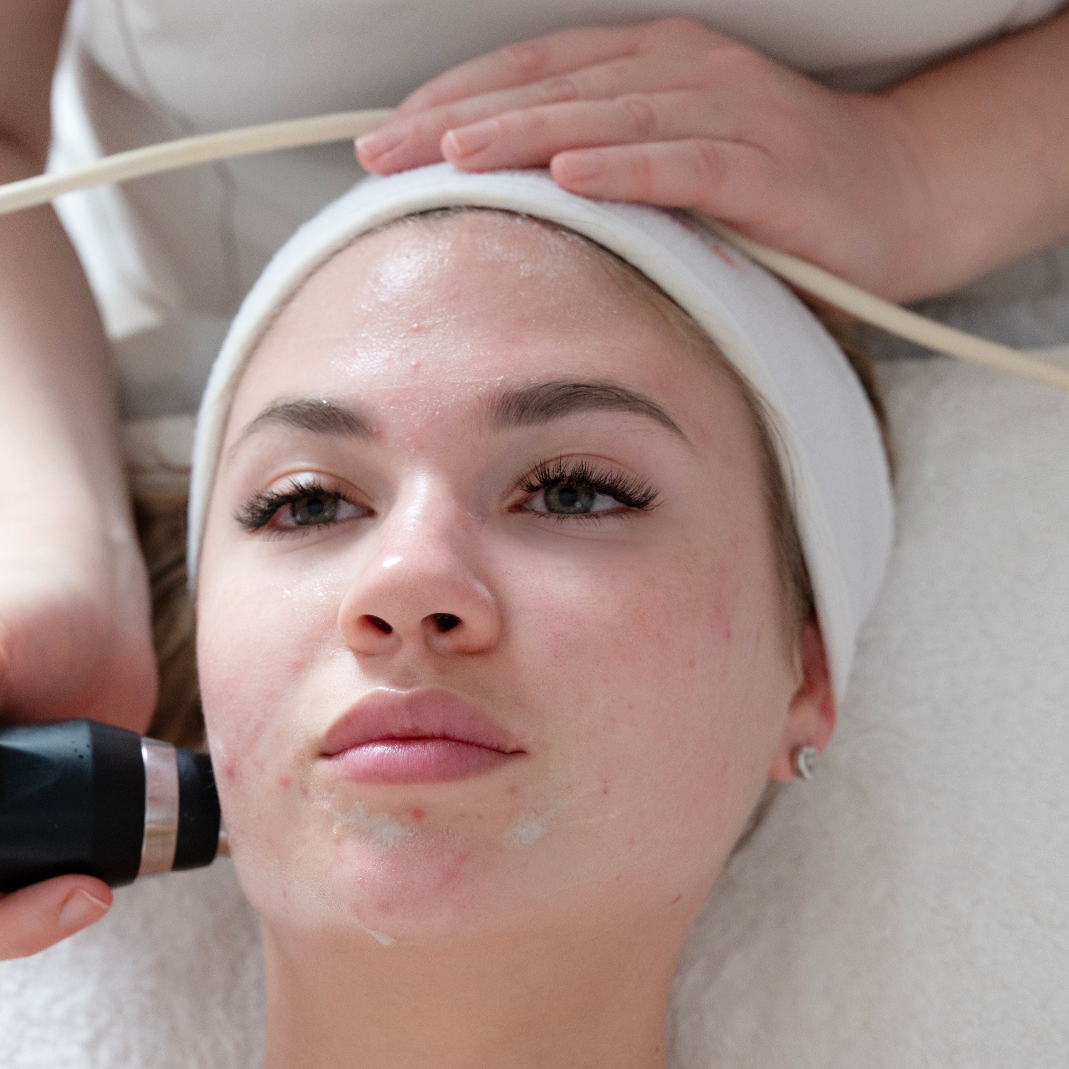 אקנה בגיל מבוגר: מה מפעיל אותו ואיך מורידים עומס מהעור